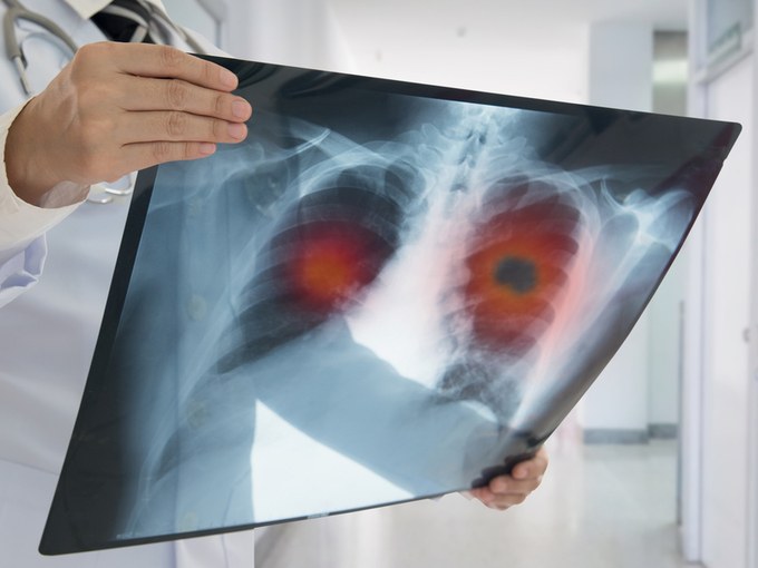 肺のレントゲン写真を見るドクター