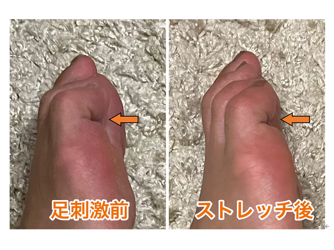 ●足刺激前（左）と小指ストレッチ後（右）の小指の状態