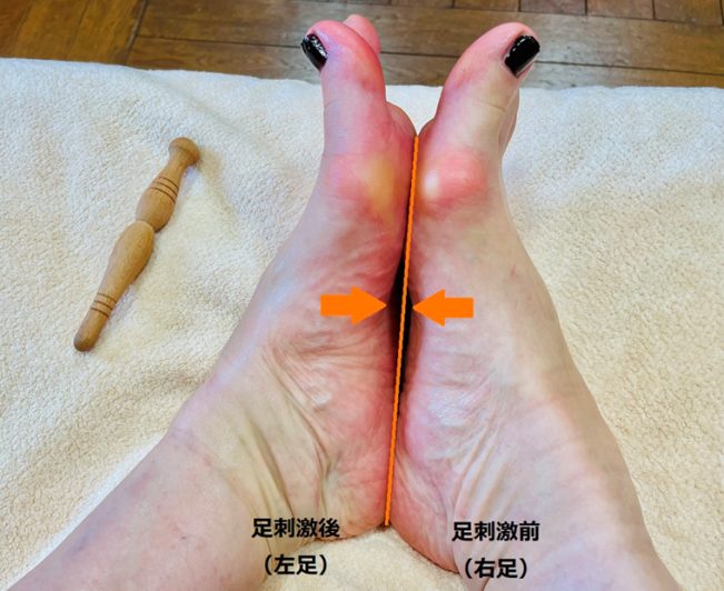 ●足刺激後の左足と、足刺激前の右足の土踏まずのアーチを比較