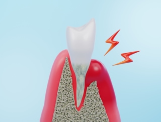 歯周病の進行度には『ジンジバリス菌』が影響!? 歯科医が解説、凶悪菌の活性を高めてしまう条件とは