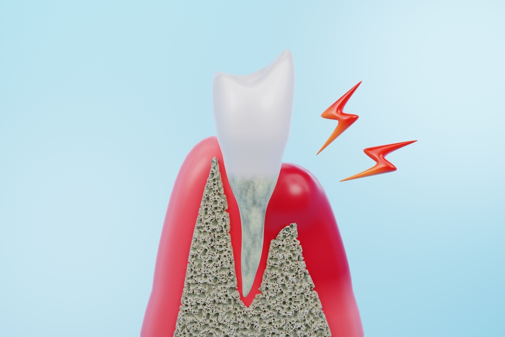 歯周病の進行度には『ジンジバリス菌』が影響!? 歯科医が解説、凶悪菌