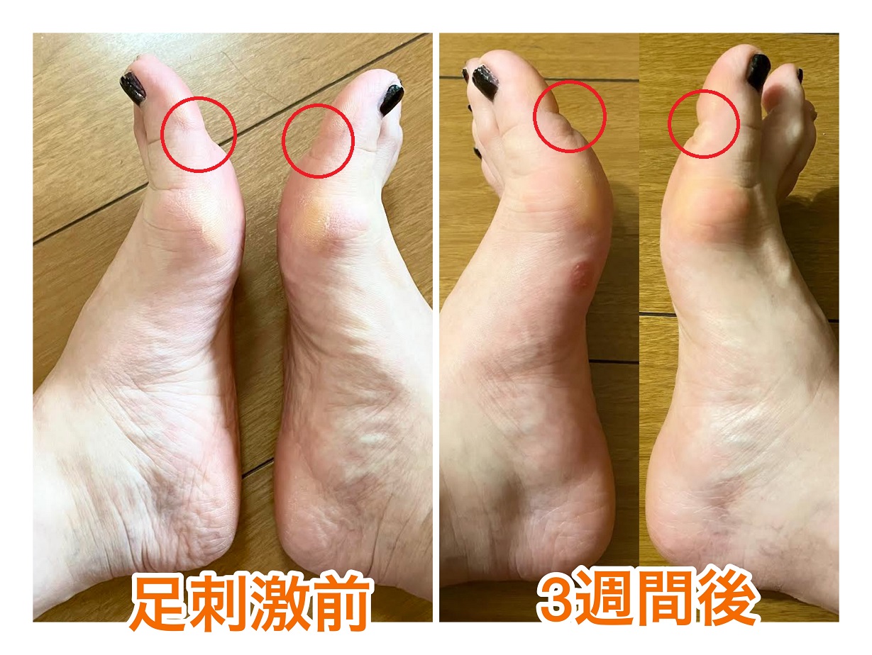 マラソン練習後の足刺激でむくみがスッキリ。腰の負担も軽くなっ