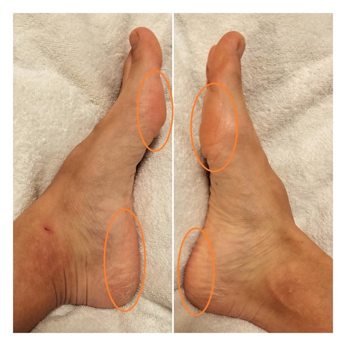 施術後の両足の側面画像