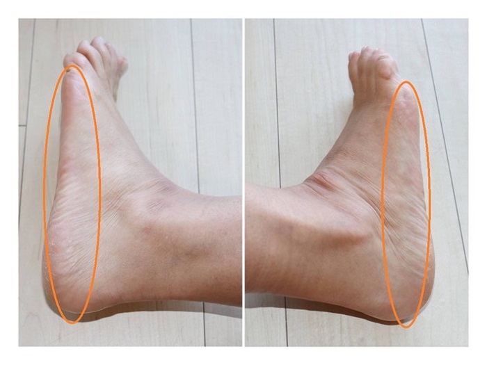 足刺激後側面画像（側面に丸印あり）