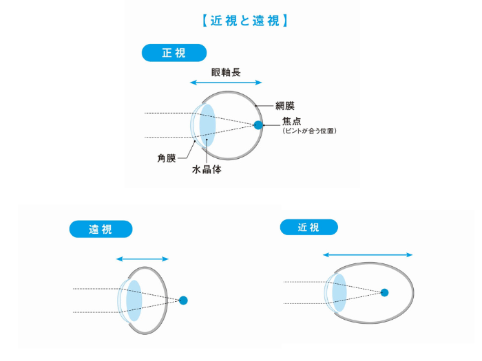 近視と遠視