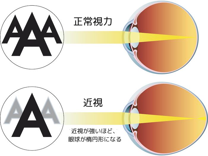 正常と近視の眼球図