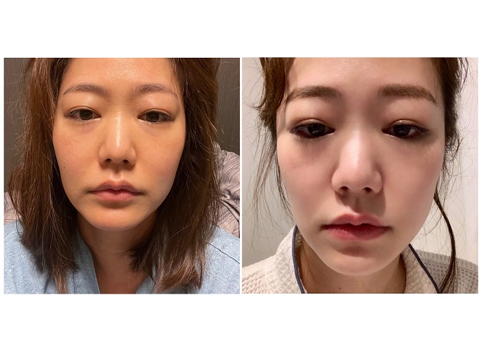 喜多さんが腸活を始める前のbefore写真