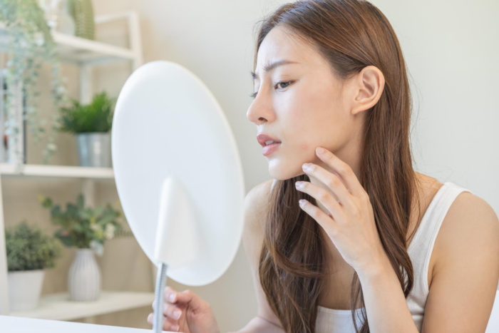 ニキビを気にしている女性
