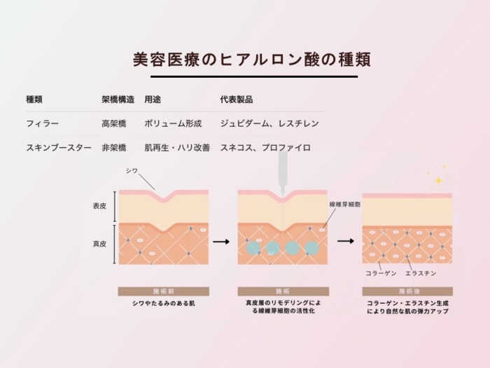 美容医療ののヒアルロン酸の種類