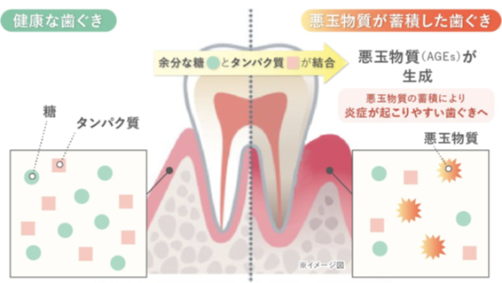 歯ぐきの糖化メカニズム