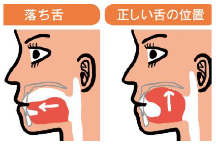 落ち舌と正しい舌の位置