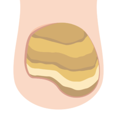 　爪甲鉤彎症の爪イラスト