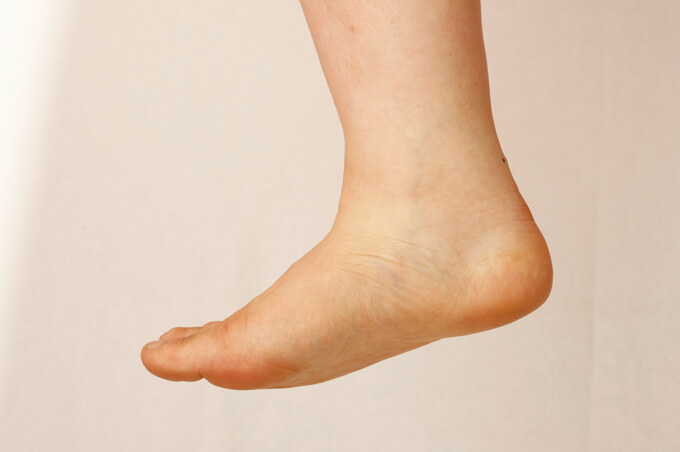 足の甲が腫れている例の足