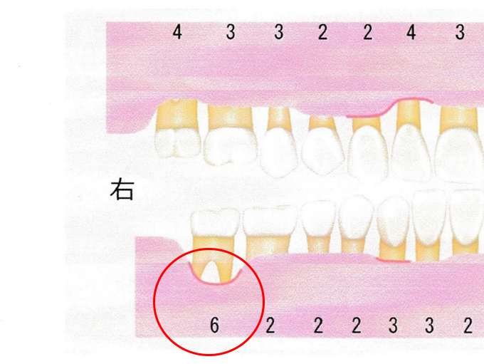 抜いた親知らずの隣の歯は 歯周ポケットが６mmだった 歯医者さんでカウンセリングを受けた結果 Omezaトーク ダイエット フィットネス ヘルスケアのことならfytte フィッテ